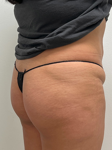Brazilian Butt Lift Before and After | Rashid Plastic Surgery