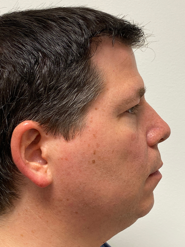 Chin Augmentation Before and After | Rashid Plastic Surgery