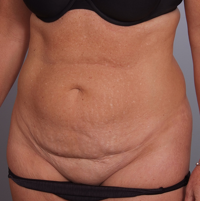 Abdominoplasty Before and After | Rashid Plastic Surgery