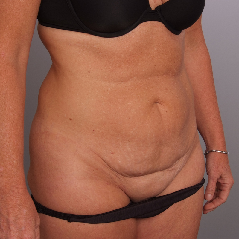 Abdominoplasty Before and After | Rashid Plastic Surgery