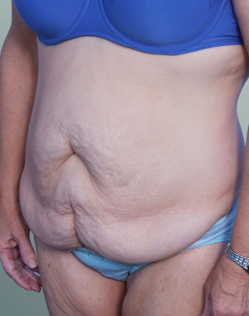 Abdominoplasty Before and After | Rashid Plastic Surgery