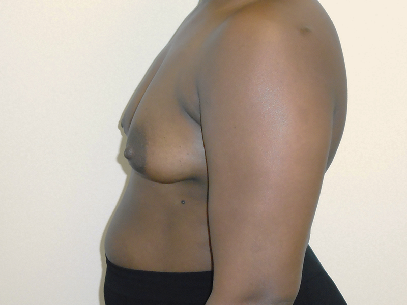 Breast Aug Before and After | Rashid Plastic Surgery