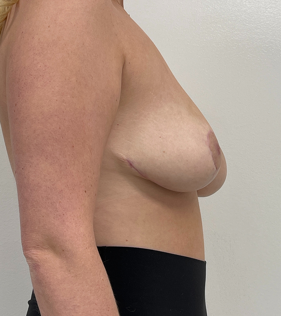 Breast Reduction Before and After | Rashid Plastic Surgery