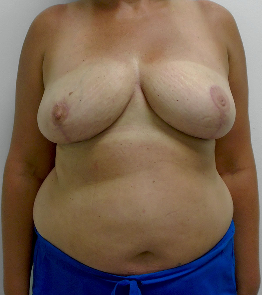 Breast Reduction Before and After | Rashid Plastic Surgery