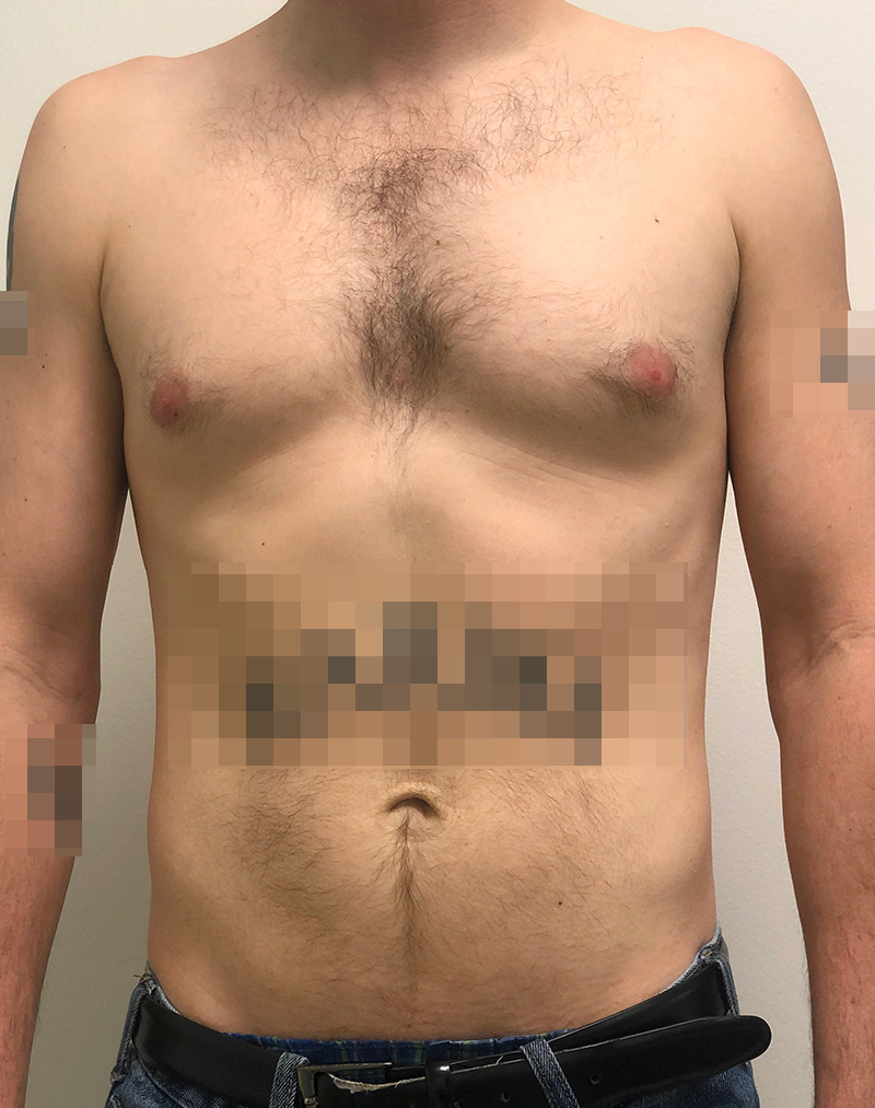 Gynecomastia Before and After | Rashid Plastic Surgery