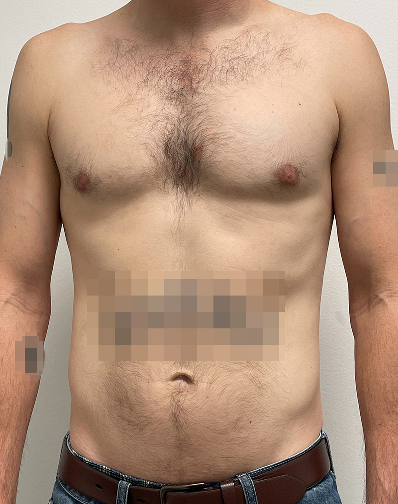 Gynecomastia Before and After | Rashid Plastic Surgery