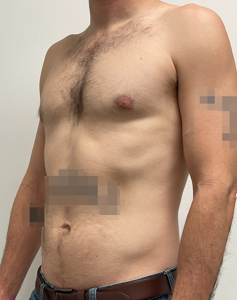 Gynecomastia Before and After | Rashid Plastic Surgery