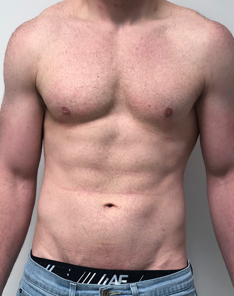 Gynecomastia Before and After | Rashid Plastic Surgery