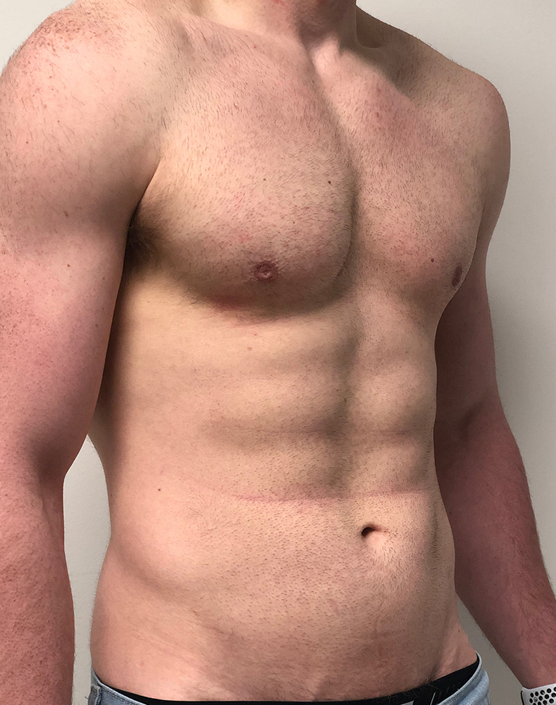 Gynecomastia Before and After | Rashid Plastic Surgery