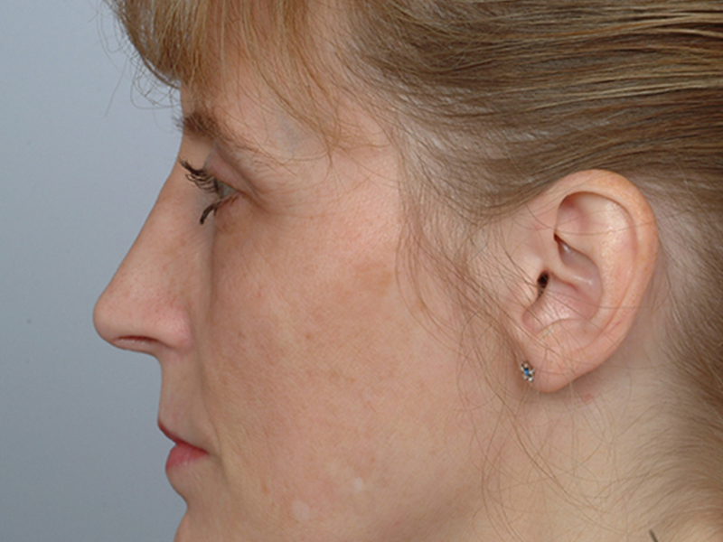 Rhinoplasty Before and After | Rashid Plastic Surgery